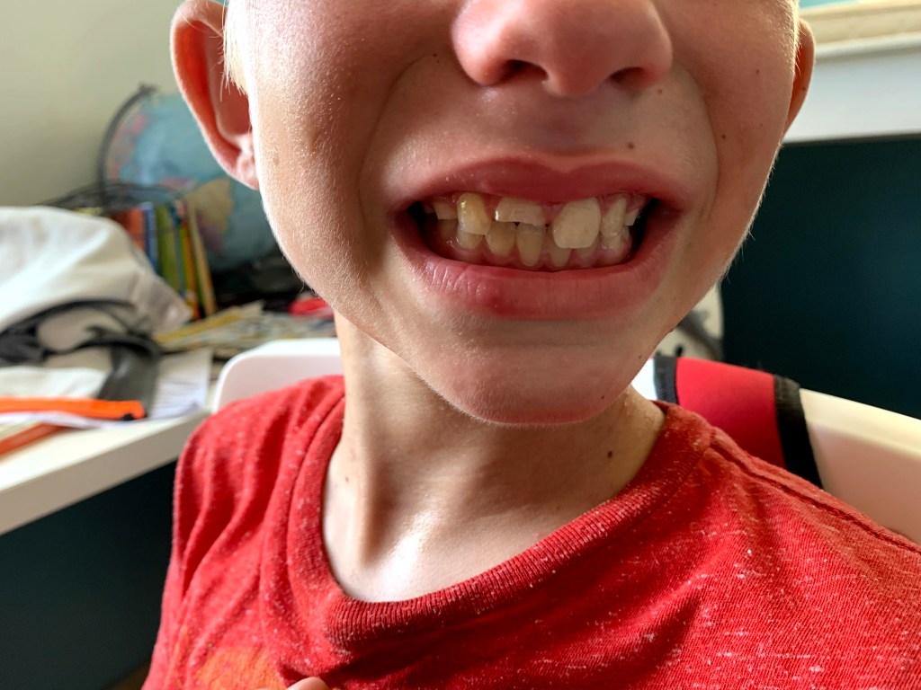 Poor Noah had a run-in with the wall, and the wall won! :(